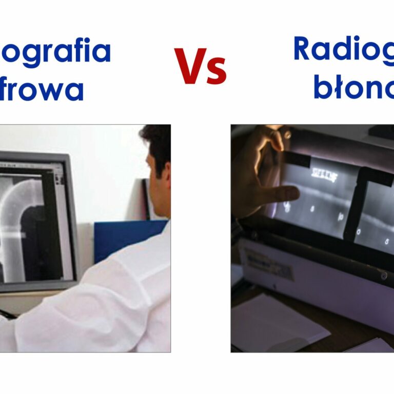 Radiografia cyfrowa versus błonowa